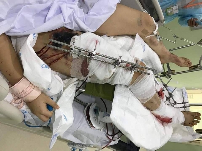 Ra Thủ đô nhập học, nữ sinh xứ Nghệ gặp tai nạn nguy kịch ra thu do nhap hoc nu sinh xu nghe gap tai nan nguy kich