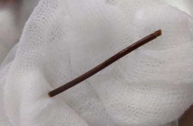 Cụ bà bị thủng dạ dày khi nuốt phải tăm tre khi xỉa răng