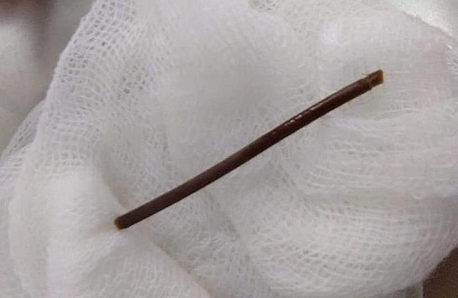 cu ba bi thung da day khi nuot phai tam tre khi xia rang