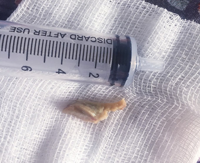 Nội soi gắp mẩu xương bò 'đi lạc' vào trong phổi suốt 3 tháng noi soi gap mau xuong bo di lac vao trong phoi suot 3 thang