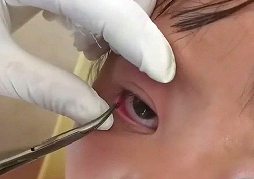 Gắp con vắt ký sinh nhiều ngày trong mắt bé gái người H’mông gap con vat ky sinh nhieu ngay trong mat be gai nguoi hmong