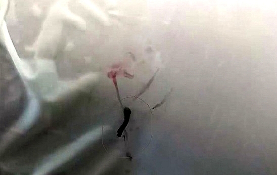 Gắp con vắt ký sinh nhiều ngày trong mắt bé gái người H’mông gap con vat ky sinh nhieu ngay trong mat be gai nguoi hmong