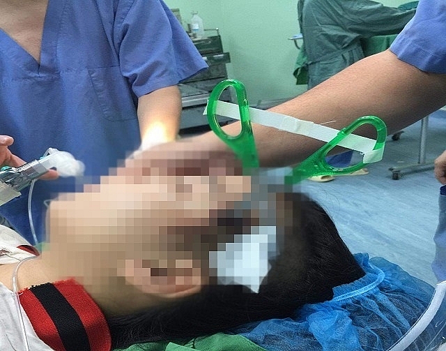 Cứu sống bé gái 10 tuổi bị kéo nhọn găm thủng xương sọ nguy hiểm tính mạng cuu song be gai 10 tuoi bi keo gam thung xuong so nguy hiem tinh mang
