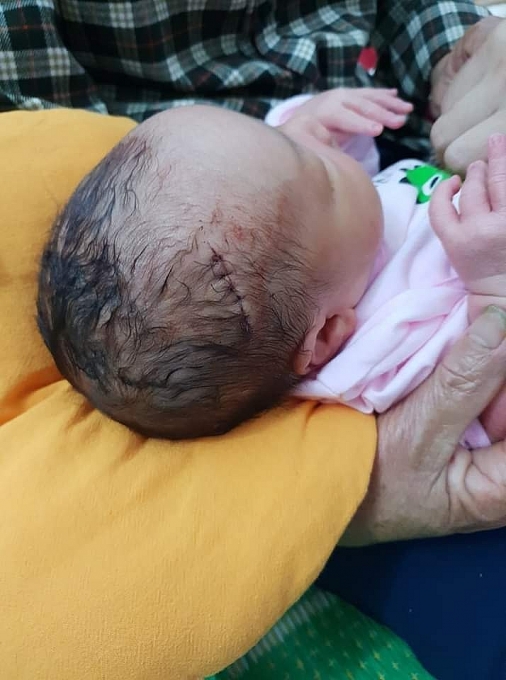 Mổ đẻ bất cẩn, bé trai sơ sinh phải khâu 6 mũi da đầu mo de bat can be trai so sinh phai khau 6 mui da dau