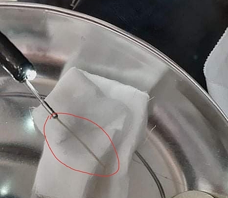 Nội soi gắp thành công tăm nhọn trong dạ dày bệnh nhân noi soi gap thanh cong tam nhon trong da day benh nhan