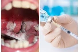 Bệnh bạch hầu "tái xuất": Bác sĩ lưu ý những điều quan trọng benh bach hau tai xuat nguy hiem bac si luu y nhung dieu quan trong