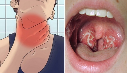 Bệnh bạch hầu "tái xuất": Bác sĩ lưu ý những điều quan trọng benh bach hau tai xuat nguy hiem bac si luu y nhung dieu quan trong